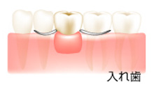 入れ歯のメリット