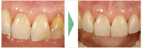 歯の修復を長期に維持・安定させるには